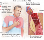 Acute Coronary Syndrome (ACS) : étude de marché pharmaceutique
