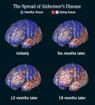 Age - Associated Memory Impairment : étude de marché pharmaceutique